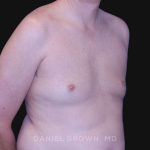 Gynecomastia Before & After Patient #10033