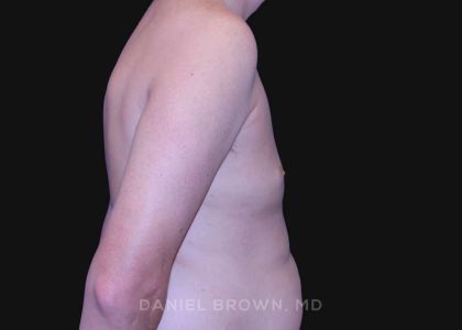 Gynecomastia Before & After Patient #10033