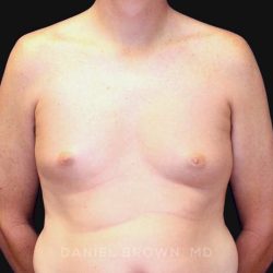 Gynecomastia Before & After Patient #10033