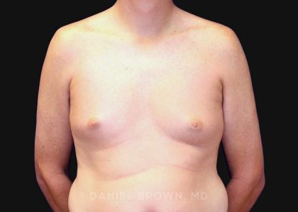 Gynecomastia Before & After Patient #10033