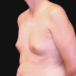 Gynecomastia Before & After Patient #10033