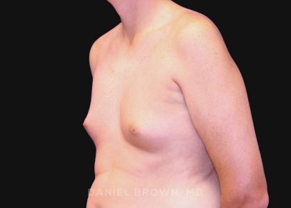 Gynecomastia Before & After Patient #10033