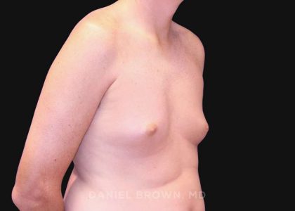 Gynecomastia Before & After Patient #10033