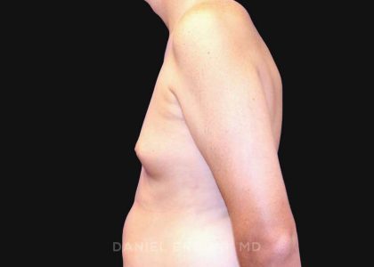 Gynecomastia Before & After Patient #10033