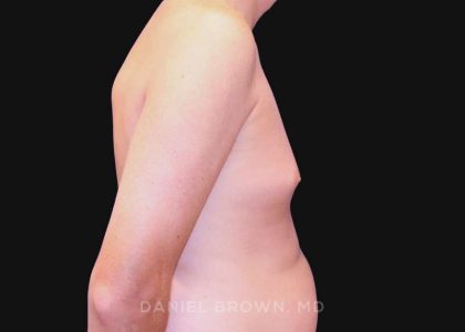 Gynecomastia Before & After Patient #10033