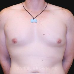 Gynecomastia Before & After Patient #10044