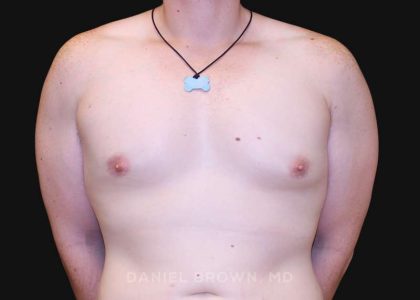 Gynecomastia Before & After Patient #10044