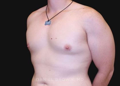 Gynecomastia Before & After Patient #10044