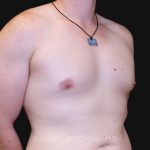 Gynecomastia Before & After Patient #10044