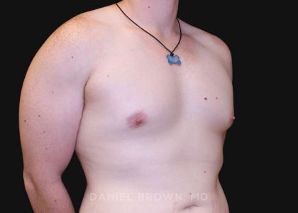 Gynecomastia Before & After Patient #10044
