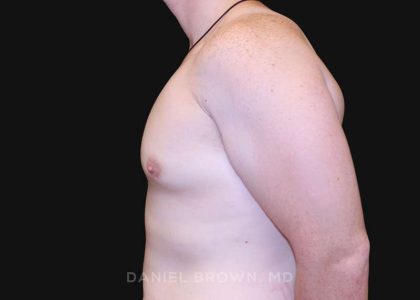 Gynecomastia Before & After Patient #10044