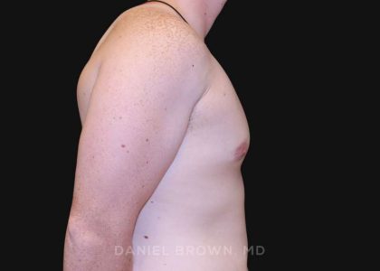 Gynecomastia Before & After Patient #10044