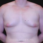 Gynecomastia Before & After Patient #10044