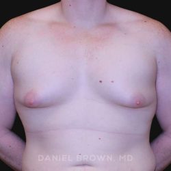 Gynecomastia Before & After Patient #10044