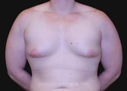 Gynecomastia Before & After Patient #10044