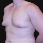 Gynecomastia Before & After Patient #10044