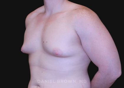 Gynecomastia Before & After Patient #10044