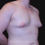 Gynecomastia Before & After Patient #10044