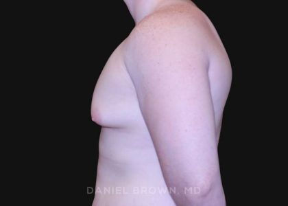 Gynecomastia Before & After Patient #10044