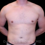 Gynecomastia Before & After Patient #10055