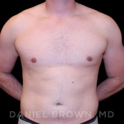 Gynecomastia Before & After Patient #10055