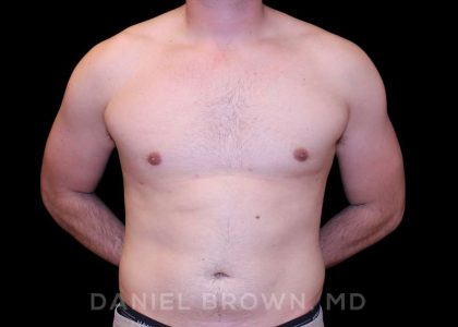 Gynecomastia Before & After Patient #10055