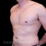 Gynecomastia Before & After Patient #10055