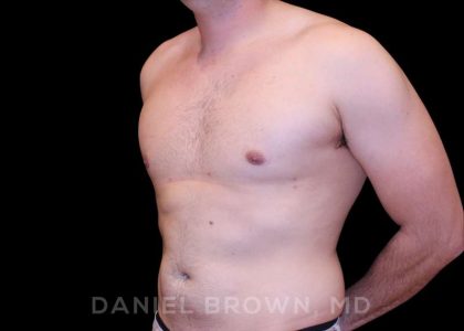 Gynecomastia Before & After Patient #10055