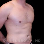 Gynecomastia Before & After Patient #10055