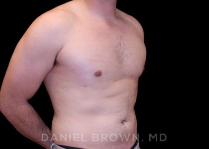 Gynecomastia Before & After Patient #10055