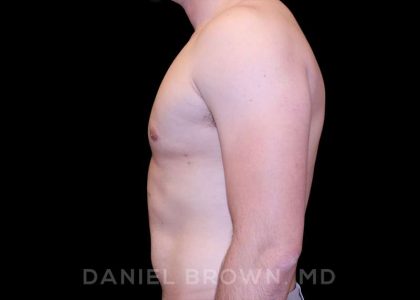 Gynecomastia Before & After Patient #10055