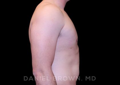 Gynecomastia Before & After Patient #10055
