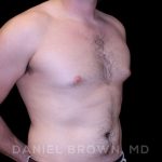 Gynecomastia Before & After Patient #10055