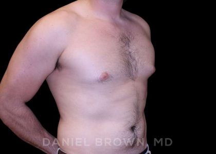 Gynecomastia Before & After Patient #10055