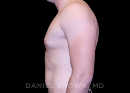 Gynecomastia Before & After Patient #10055