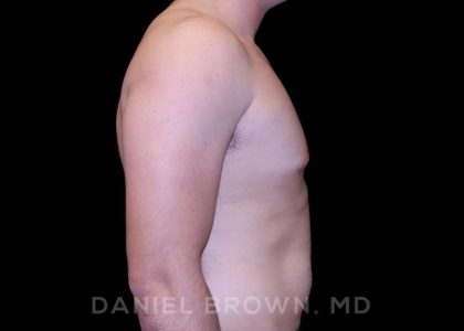 Gynecomastia Before & After Patient #10055