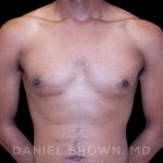 Gynecomastia Before & After Patient #10066