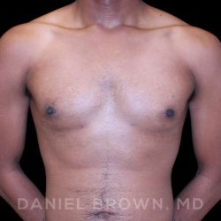 Gynecomastia Before & After Patient #10066