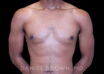 Gynecomastia Before & After Patient #10066