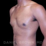 Gynecomastia Before & After Patient #10066