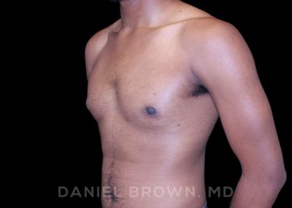 Gynecomastia Before & After Patient #10066
