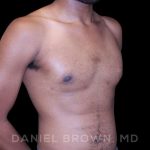 Gynecomastia Before & After Patient #10066