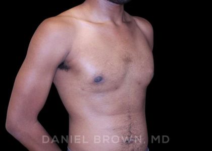 Gynecomastia Before & After Patient #10066