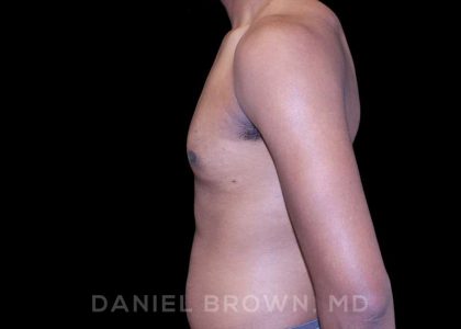 Gynecomastia Before & After Patient #10066