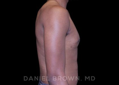 Gynecomastia Before & After Patient #10066