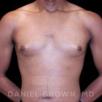 Gynecomastia Before & After Patient #10066