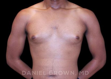Gynecomastia Before & After Patient #10066