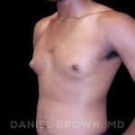 Gynecomastia Before & After Patient #10066