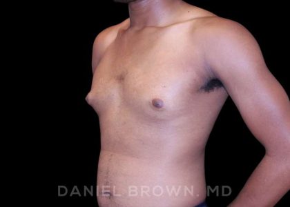 Gynecomastia Before & After Patient #10066