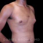 Gynecomastia Before & After Patient #10066